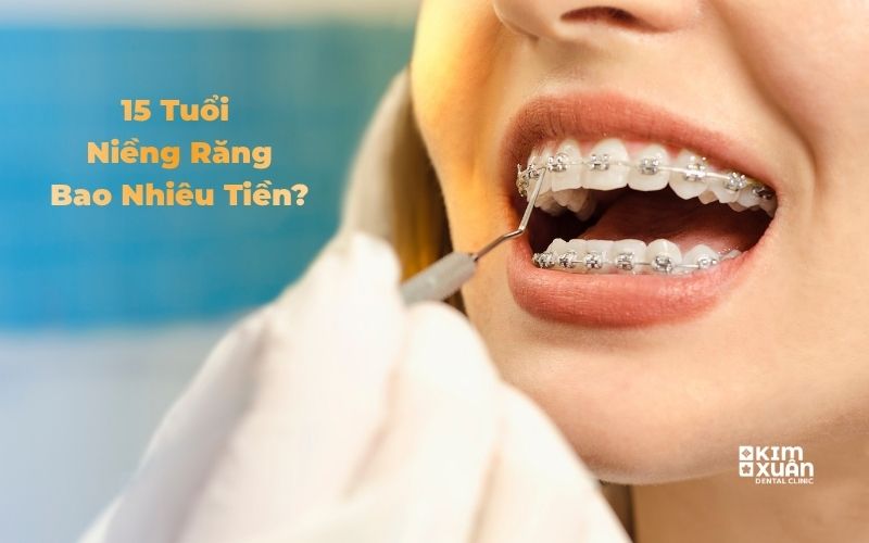 15 tuổi niềng răng bao nhiêu tiền