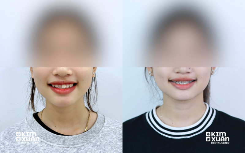 20 Tuổi Niềng Răng Chỉnh Nha Có Được Không