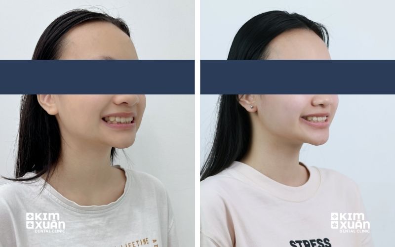 20 Tuổi Niềng Răng Tại Nha Khoa Kim Xuân