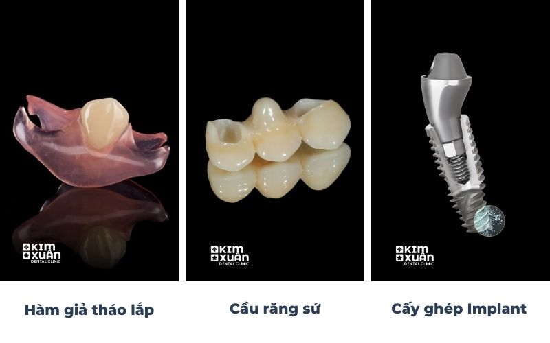 3 phương pháp trồng răng khi mất chân răng