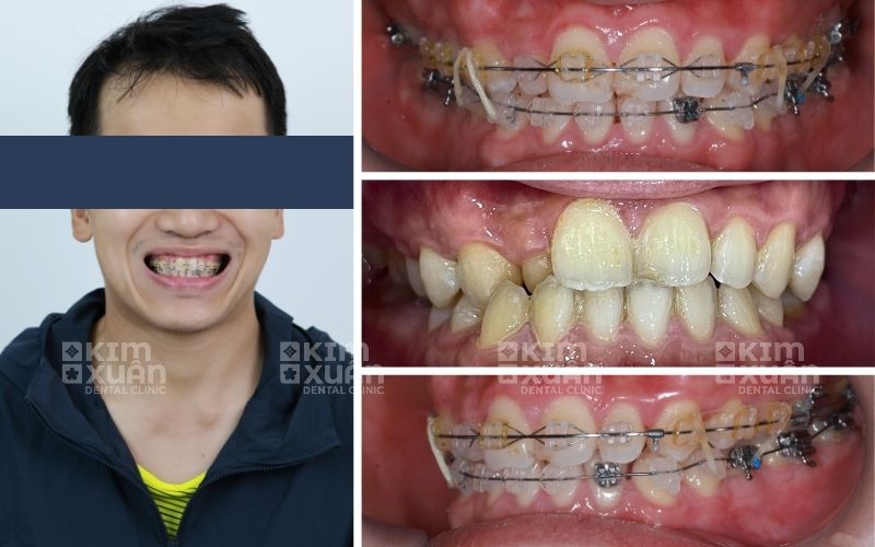 30 Tuổi Niềng Răng Tại Nha Khoa Kim Xuân