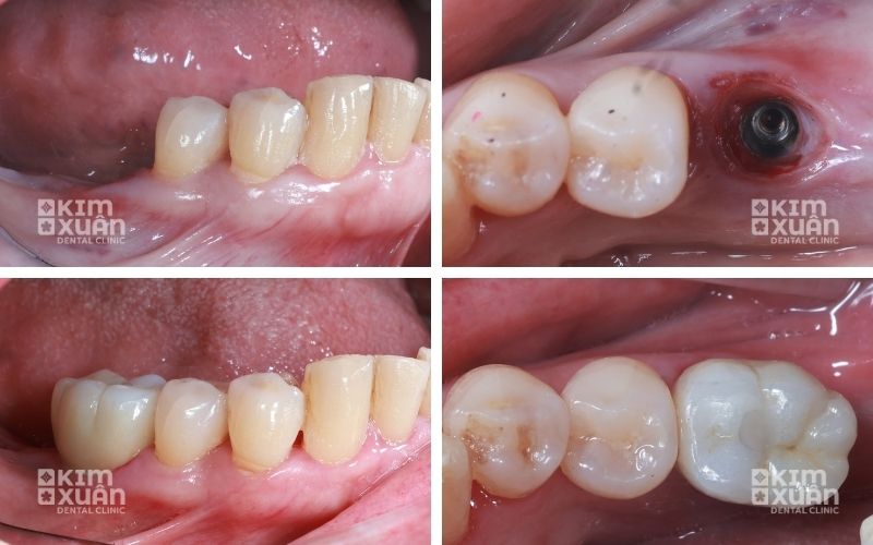 Ảnh Biểu Hiện Tiêu Xương Hàm