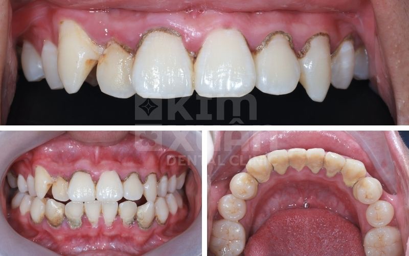 Ảnh Cao Răng Khi Chưa Được Lấy