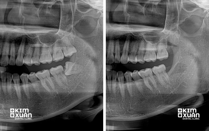 Ảnh Trước Và Chụp Phim Trước Và Sau Khi Nhổ Răng 