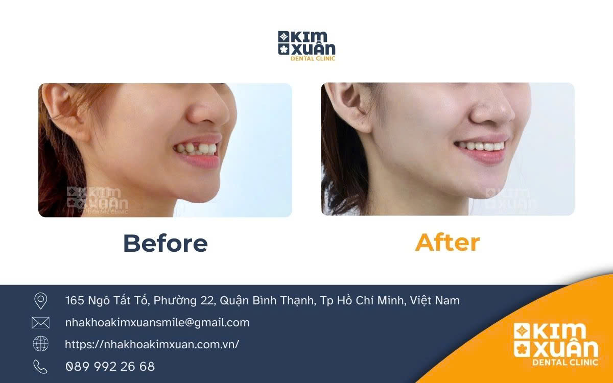 Ảnh Niềng Răng Trước Và Sau