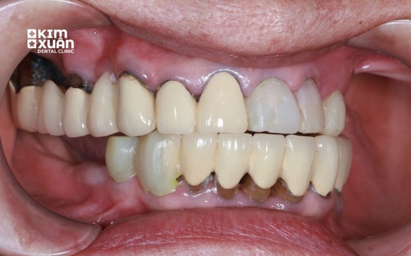 Ảnh Răng Sứ Bị Hở
