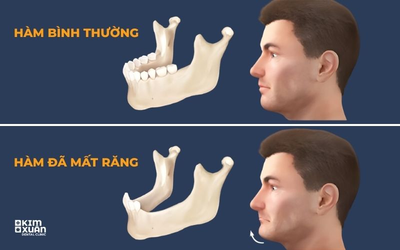 Ảnh Tiêu Xương Hàm Khi Bị Mất Răng