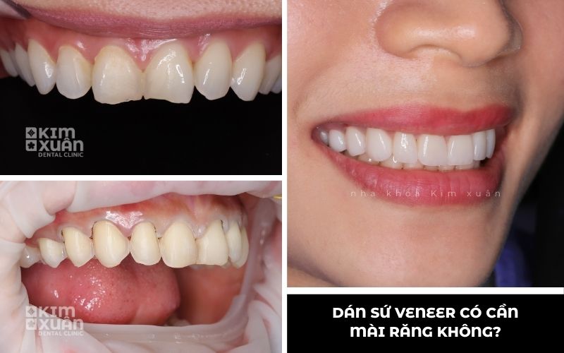 Ảnh Trước Và Sau Khi Dán Sứ Veneer Không Mài