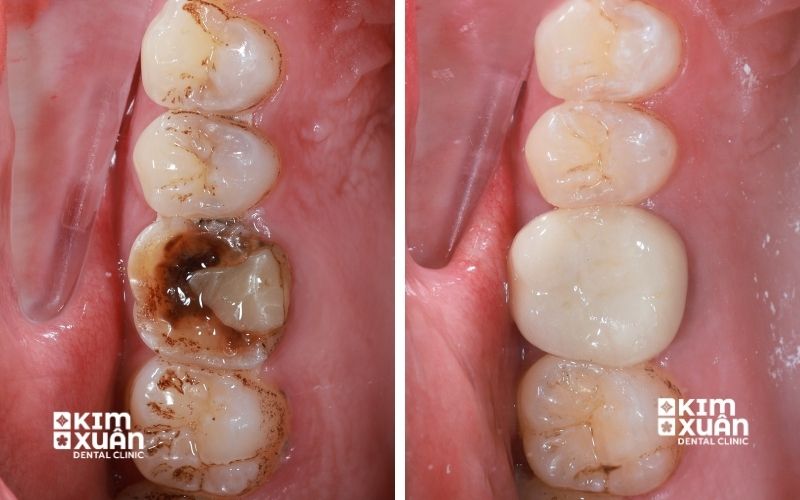 Ảnh Trước Sau Khi Lấy Tủy Bọc Răng Sứ