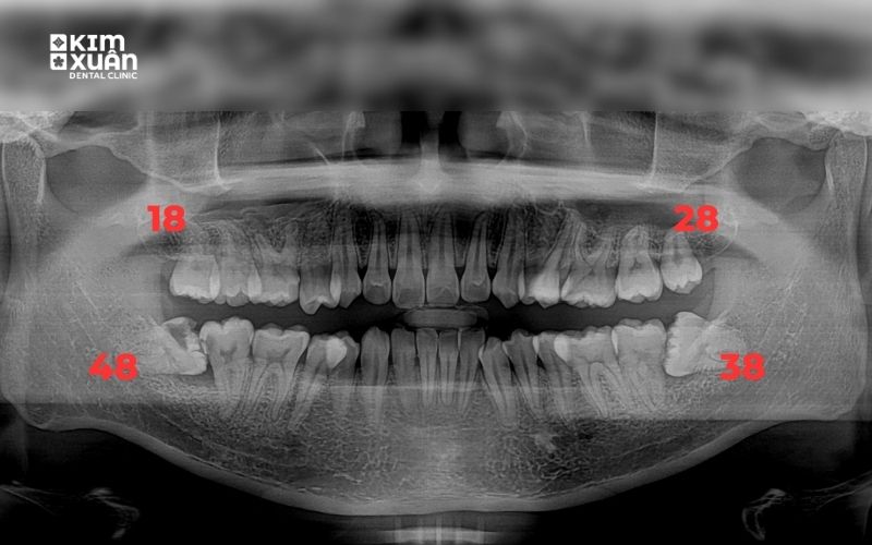 Ảnh Trước Và Sau Khi Nhổ Răng Tại Nha Khoa Kim Xuân