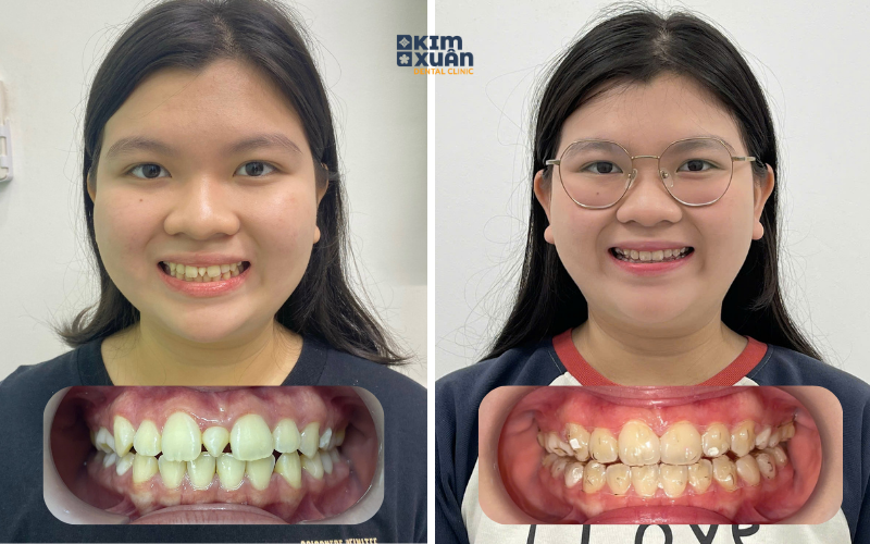 Ảnh Trước Sau Khi Niềng Răng Invisalign