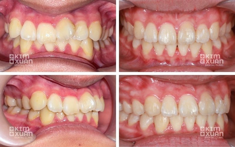 Ảnh Trước Và Sau Khi Niềng Răng Ở Tuổi 20