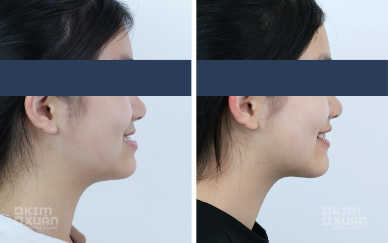 Ảnh Trước Và Sau Khi Niềng Răng Tại Nha Khoa Kim Xuân