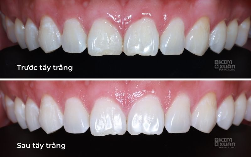 Ảnh Trước Sau Khi Tẩy Trắng Răng Tại Nha Khoa Kim Xuân