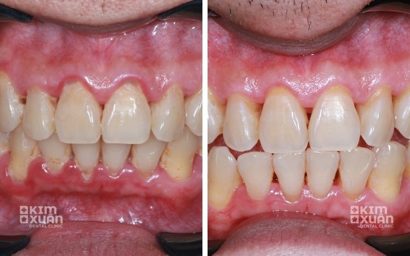 Ảnh Trước Sau Khi Tẩy Trắng Răng Bị Ố Vàng