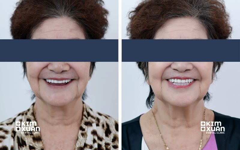 Ảnh Trước Sau Khi Trồng Răng Implant Cho Người Già