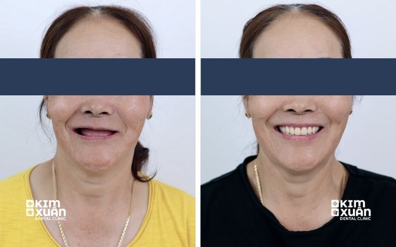 Ảnh Trước Sau Khi Trồng Răng Implant Cho Người Lớn Tuổi Tại Nha Khoa Kim Xuân