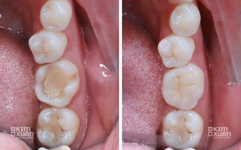 Ảnh Trước Sau Khi Lấy Tuy Răng Và Bọc Răng Sứ