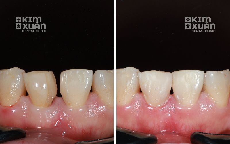 Ảnh Trước Sau Trám Răng Cửa Bị Thưa