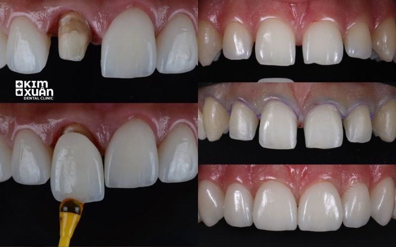 Ảnh Trước Và Sau Khi Bọc Sứ Răng Cửa