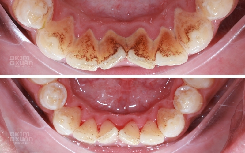 Ảnh Trước Và Sau Khi Cạo Vôi Răng Tại Nha Khoa Kim Xuân Bình Thạnh