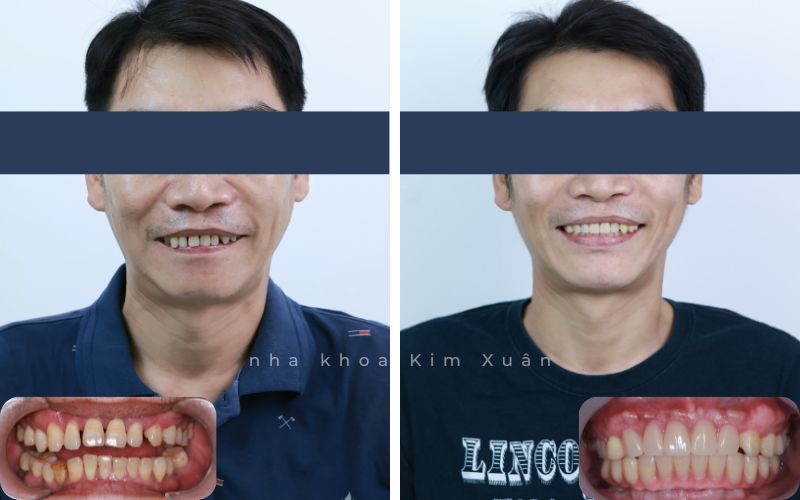 Ảnh Trước Và Sau Khi Cấy Ghép Implant Tại Nha Khoa Kim Xuân Bình Thạnh - TP. HCM
