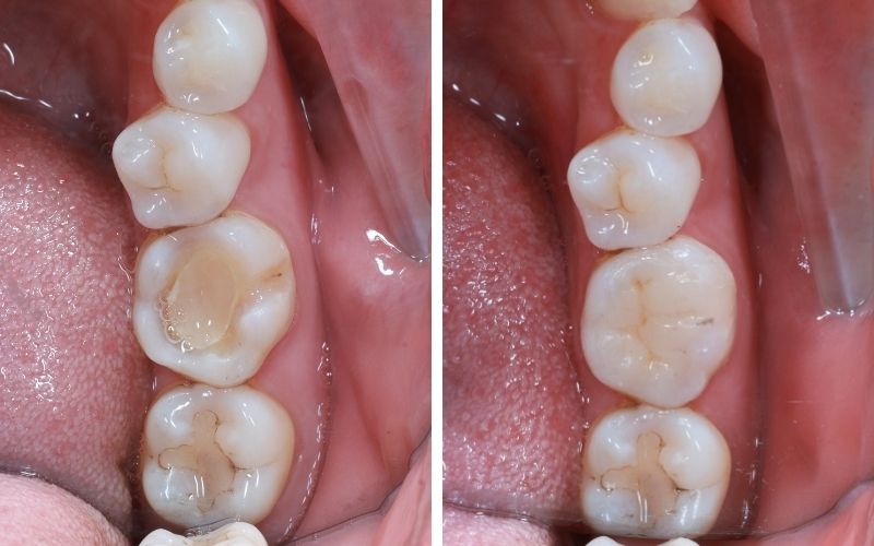 Ảnh Trước Và Sau Khi Chữa Răng Sâu Tại Nha Khoa Kim Xuân