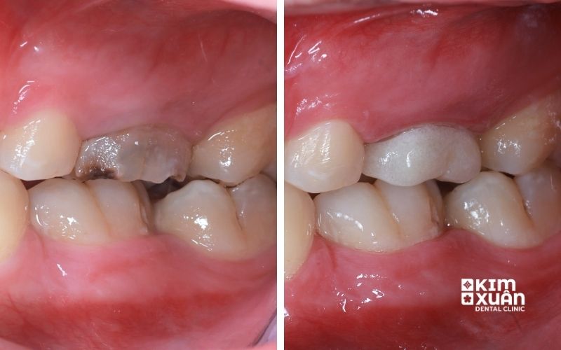 Ảnh Trước Và Sau khi Chữa trị Viêm Tủy Răng Sưng Má