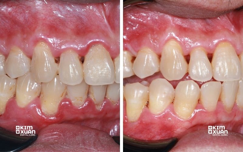 Ảnh Trước Và Sau Khi Chữa Tụt Lợi