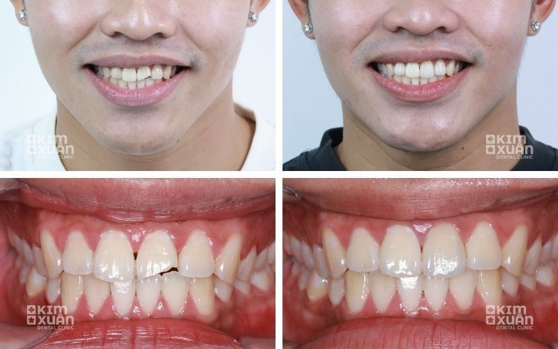 Ảnh Trước Và Sau Khi Dán Sứ Veneer 2 Răng Cửa Thưa