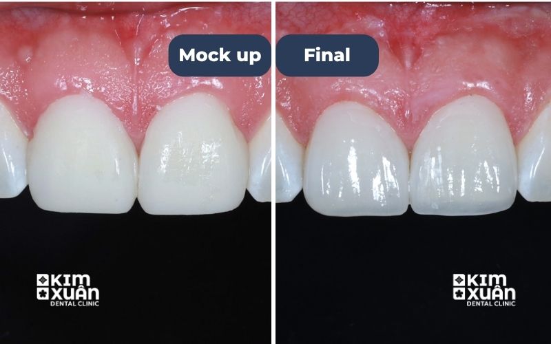 Ảnh Trước Và Sau Khi Dán Sứ Veneer