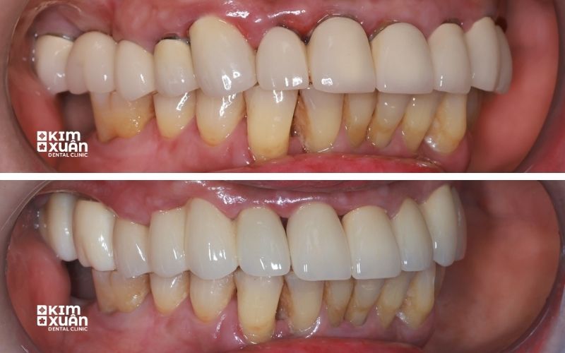 Ảnh Trước Và Sau Khi Điều Trị Bọc Sứ Bị Viêm Lợi