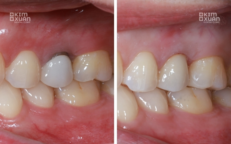 Ảnh Trước Và Sau Khi Điều Trị Bọc Răng Sứ Bị Hở