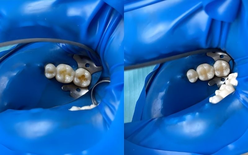 Ảnh Trước Và Sau Khi Điều Trị răng Chết Tủy