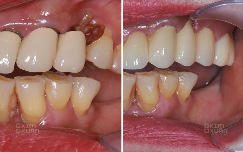 Ảnh Trước Và Sau Khi Điều Trị Răng Sứ Bị Hở