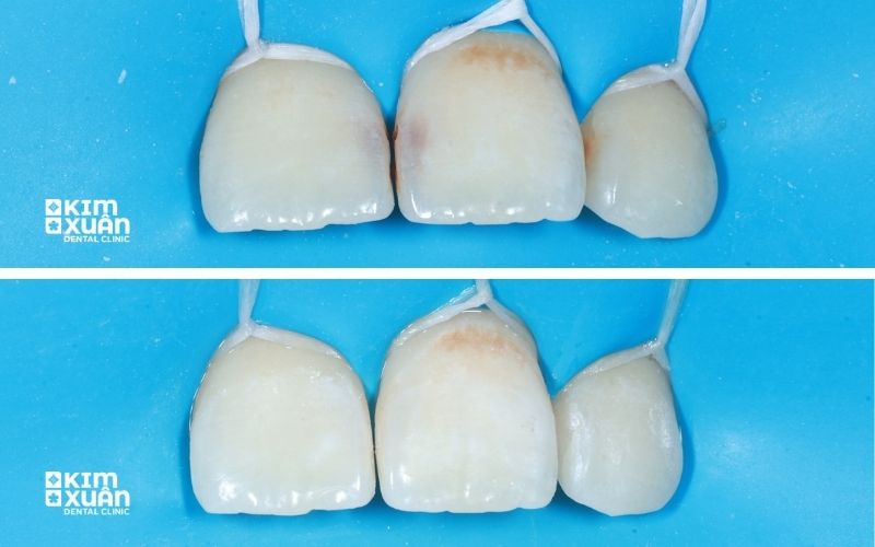 Ảnh trước Và Sau Khi Điều Trị Sâu Răng Cửa