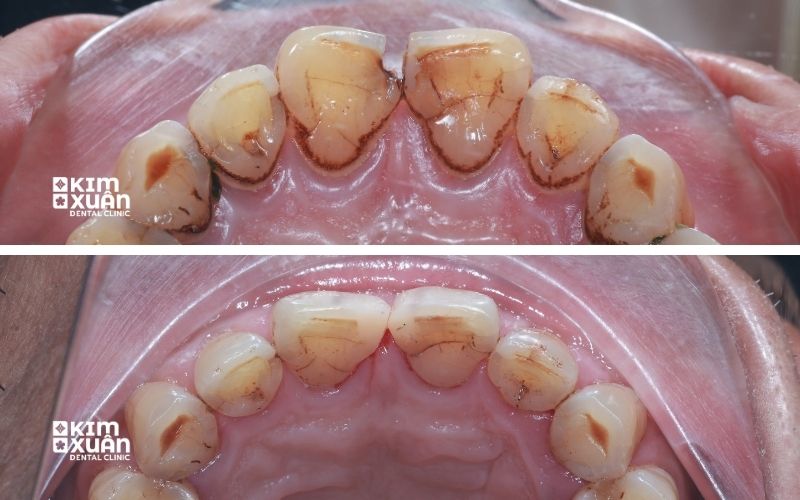 Ảnh Trước Và Sau Khi Điều Trị Sâu Răng Cửa Tại Nha Khoa Kim Xuân