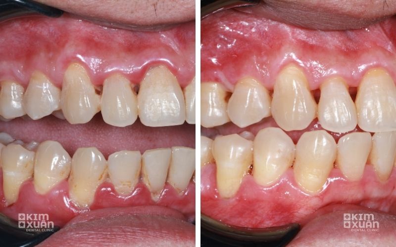 Ảnh Trước Và Sau Khi Điều Trị Tụt Lợi Chân Răng