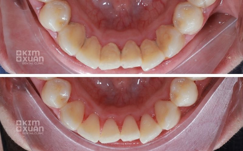 Ảnh Trước Và Sau Khi Lấy Cao Răng Tại Nha Khoa Kim Xuân