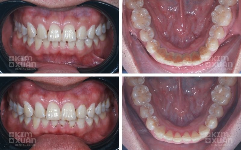 Ảnh Trước Và Sau Khi Lấy Cao Răng Tại Nha Khoa Kim Xuân
