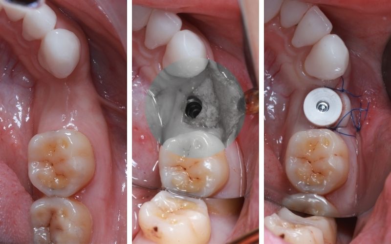 Ảnh Trước và Sau Khi Nhổ Răng Và Cấy Ghép Impalnt