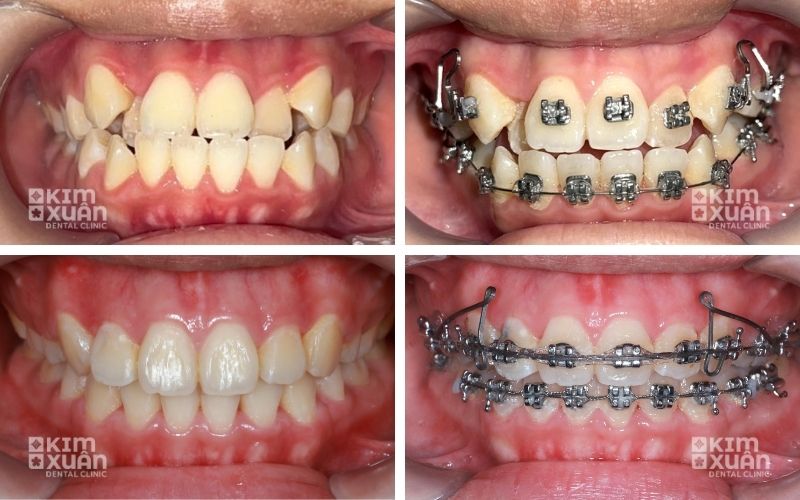 Ảnh Trước Và Sau Khi Niềng Răng Mắc Cài Kim Loại