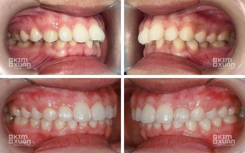 Ảnh trước Và Sau Khi Niềng Răng Mắc Cài Kim Loại Tại Nha Khoa Kim Xuân