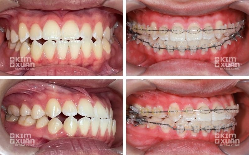 Ảnh Trước Và Sau Khi Niềng Răng Mắc Cài Sứ Tại Nha Khoa Kim Xuân