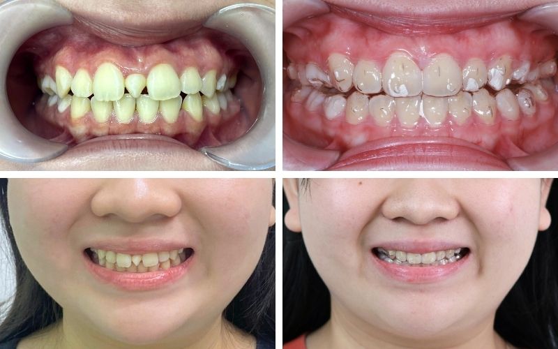 Ảnh Trước Và Sau Khi Niềng Răng Invisalign Tại Nha Khoa Kim Xuân