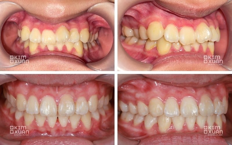 Ảnh Trước Và Sau Khi Niềng Răng Tại Nha Khoa Kim Xuân