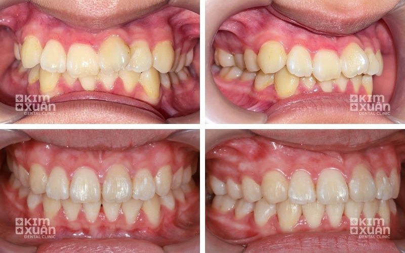 Ảnh Trước Và Sau Khi Niềng Răng Tại Nha Khoa Kim Xuân