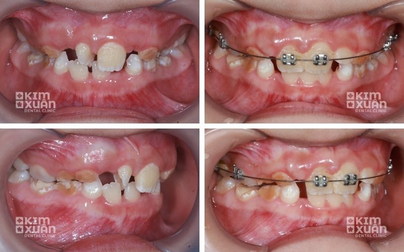 Ảnh Trước Và Sau Khi Niềng Răng Trẻ Em Tại Nha Khoa Kim Xuân