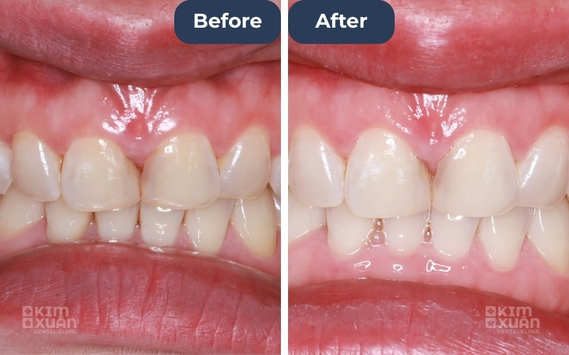 Ảnh Trước Và Sau Khi Tẩy Trắng Tại Nha Khoa Kim Xuân