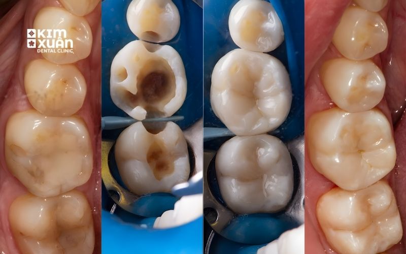 Ảnh Trước Và Sau Khi Trám Răng 